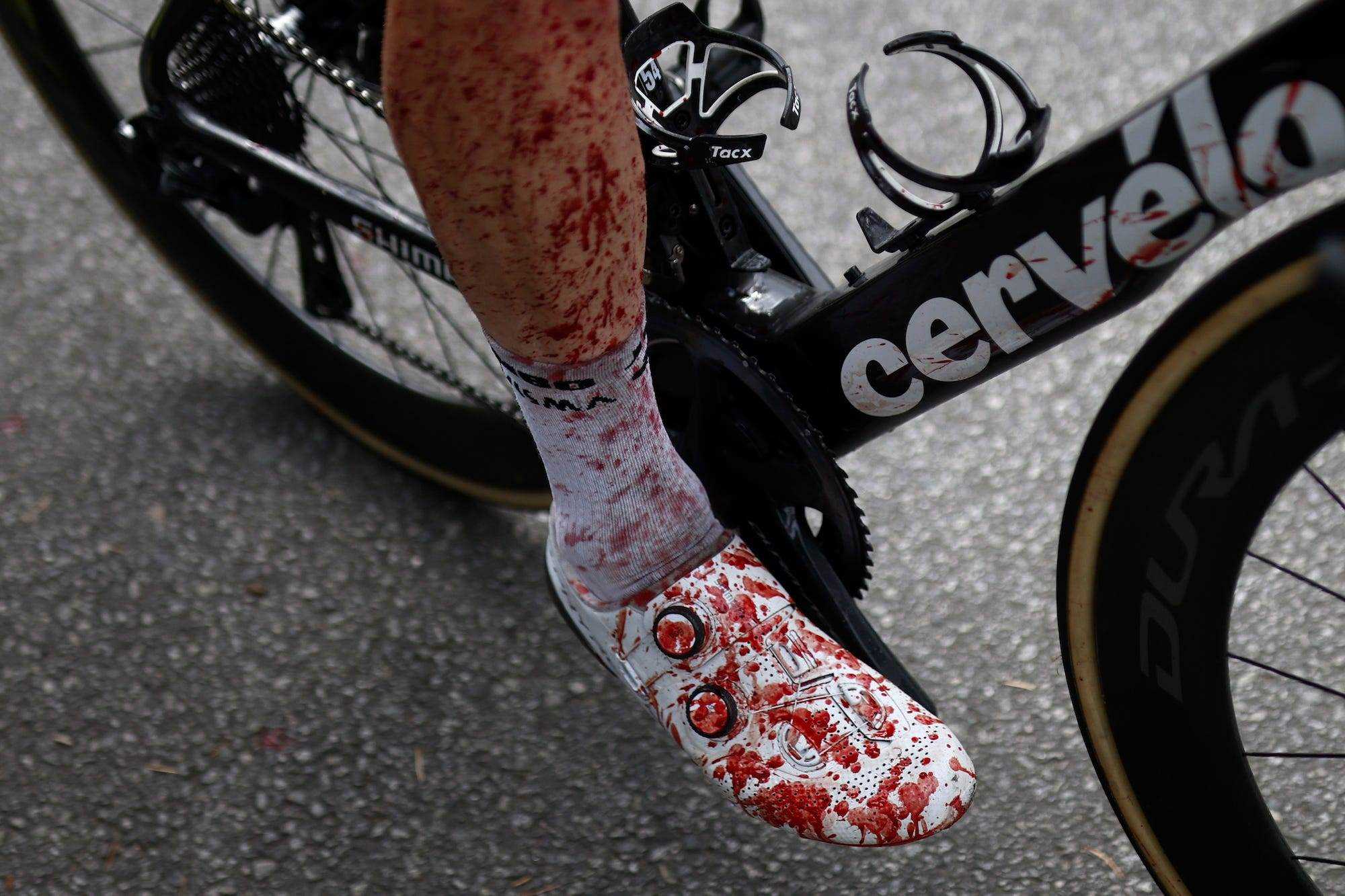 Blut an Bein und Schuh des Niederländers Steven Kruijswijk, der bei der dritten Etappe der Tour de France stürzte.