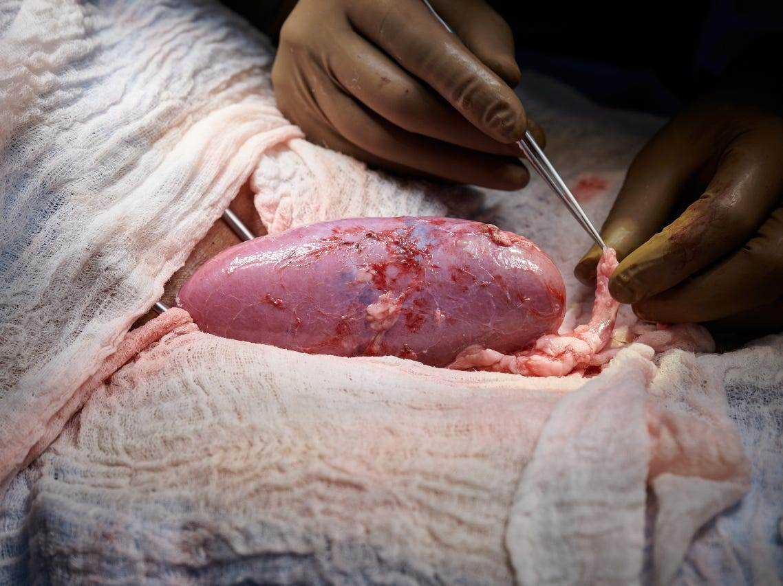 Eine Schweineniere, die chirurgisch an den Blutgefäßen des Beins eines menschlichen Patienten befestigt wurde