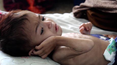 Sie ist fast 3, aber so klein wie ein Säugling.  Das ist das Gesicht der Hungerkrise in Afghanistan