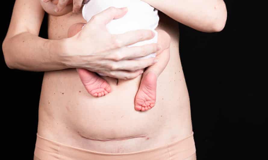 Eine Kaiserschnittnarbe, 30 Tage nach der Geburt.