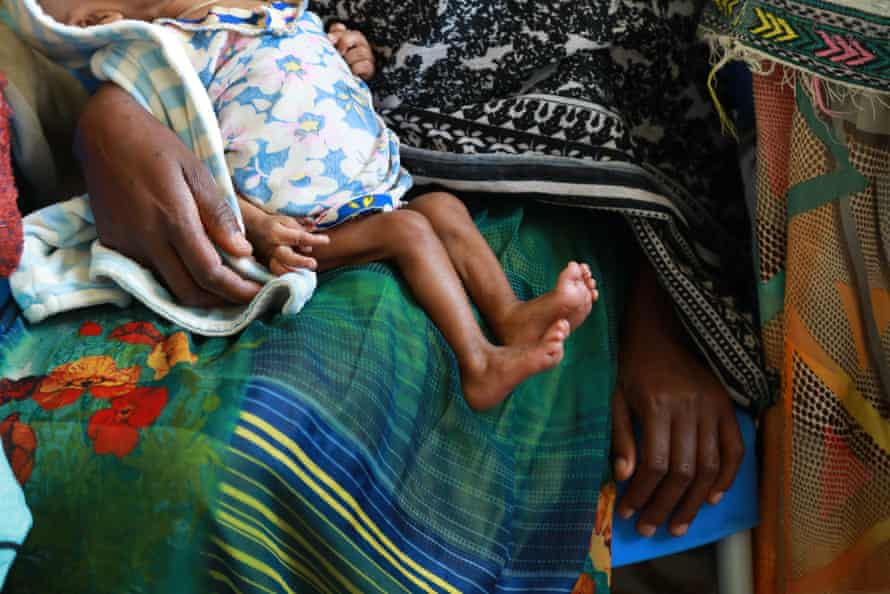 Eine Mutter hält ein schwer unterernährtes Baby auf ihrem Schoß