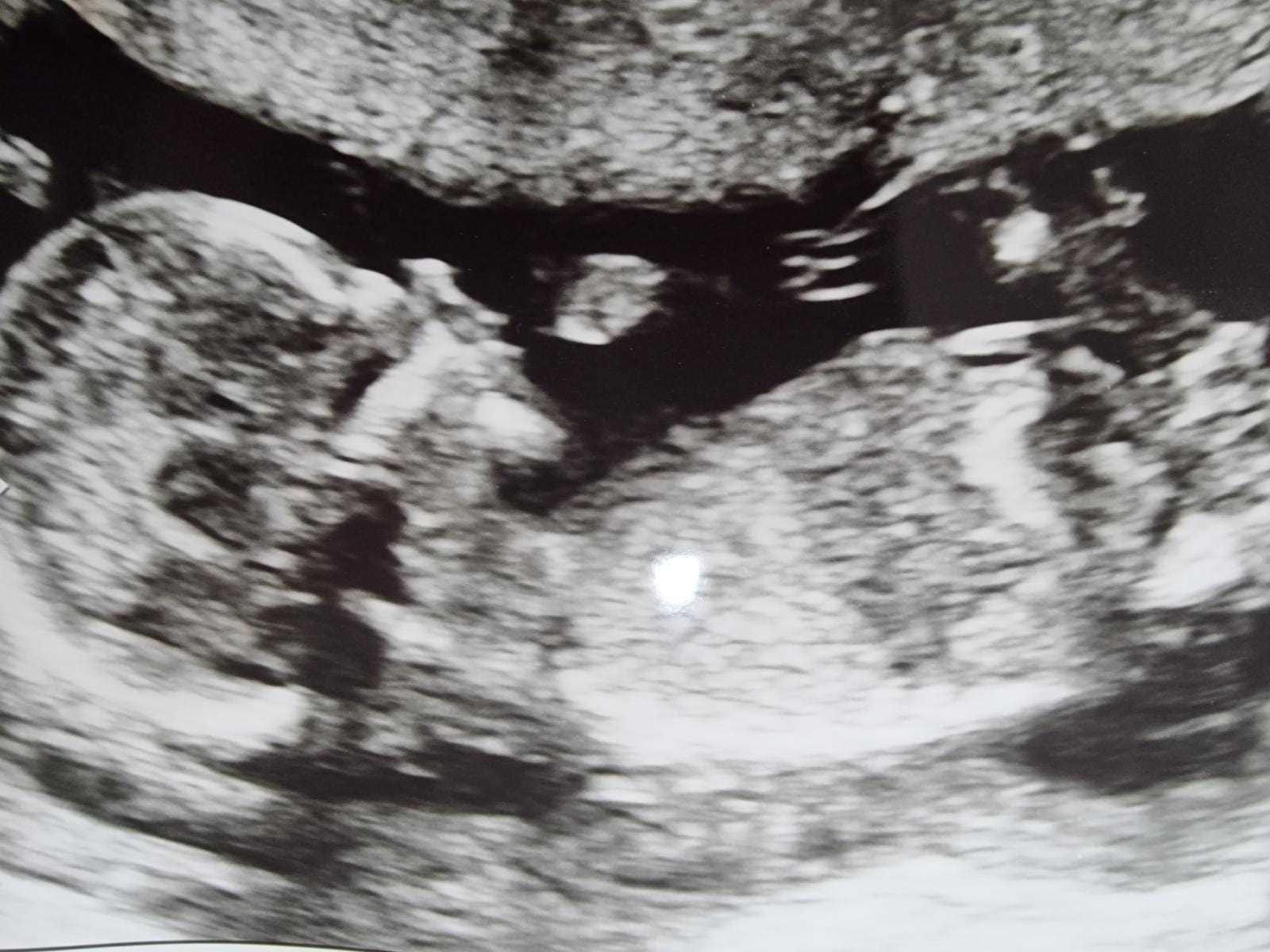 Die Ultraschalluntersuchung von Dorothea, die während der 16. Schwangerschaftswoche von Fenrych durchgeführt wurde, zeigte die Probleme mit ihrem Herzen.