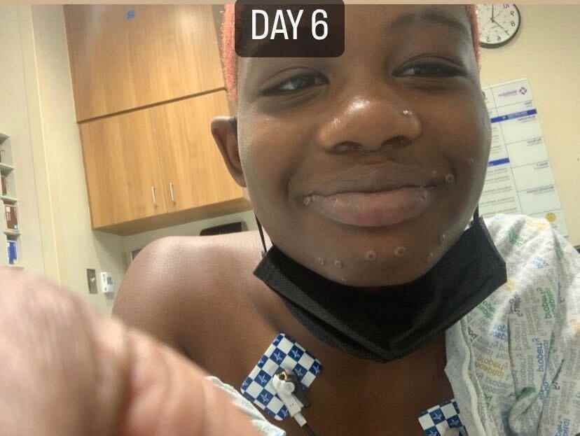 Foto zeigt Tag 6, nachdem sich Camille Seaton, 20, mit dem Affenpockenvirus infiziert hatte.