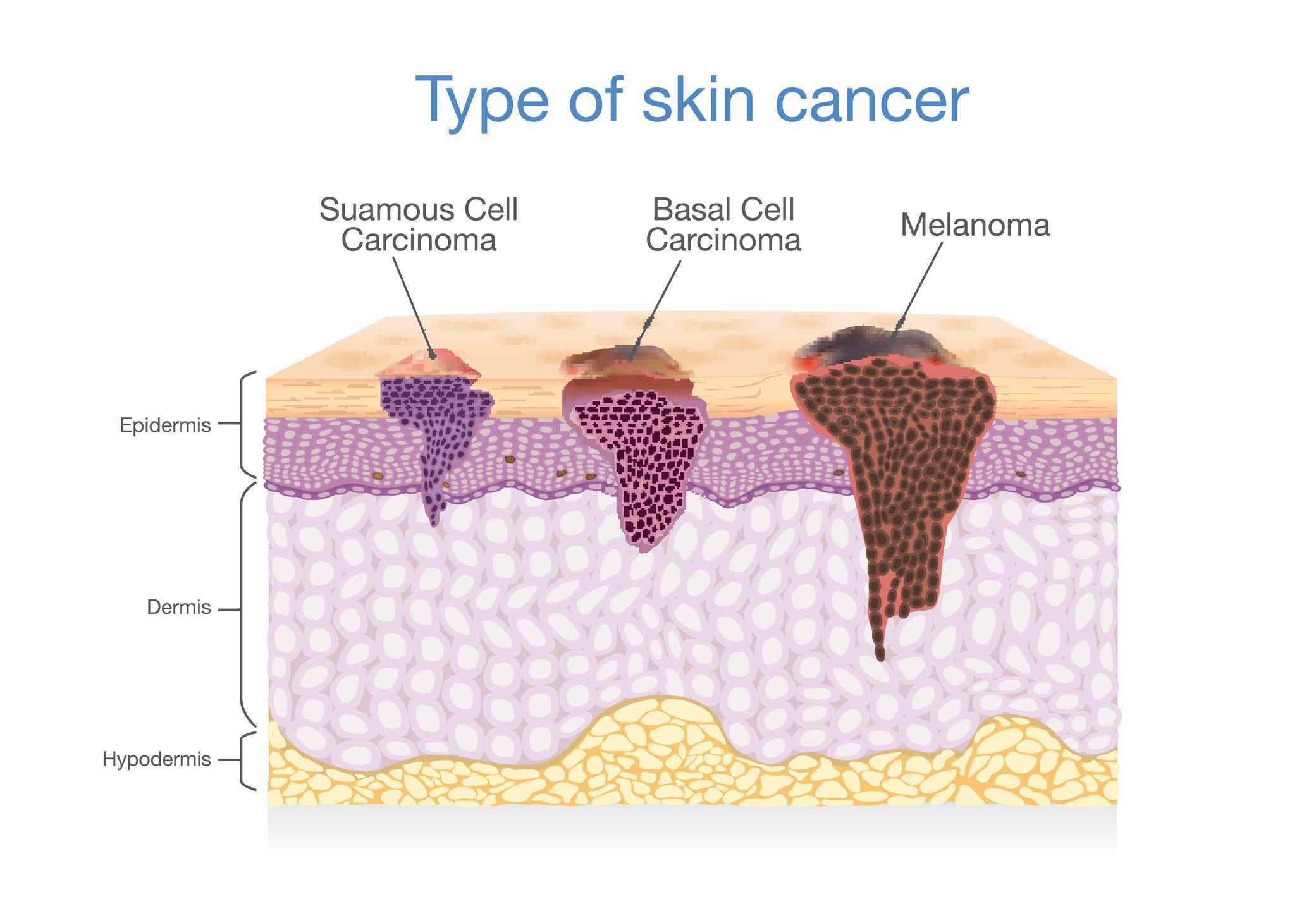 Grafik, die die drei Arten von Hautkrebs beschreibt: Melanom, Basalzellkarzinom und Plattenepithelkarzinom.