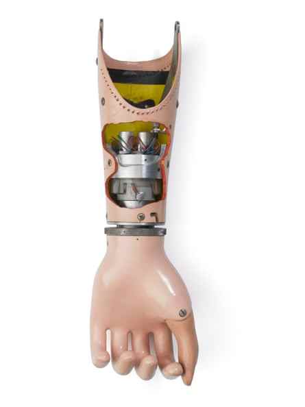 Künstliches Handprothesengerät, das mit Kohlendioxid betrieben wird und zwei Miniatur-Rollhülsenventile verwendet, vervollständigt den Unterarm mit Handgelenkrotator.