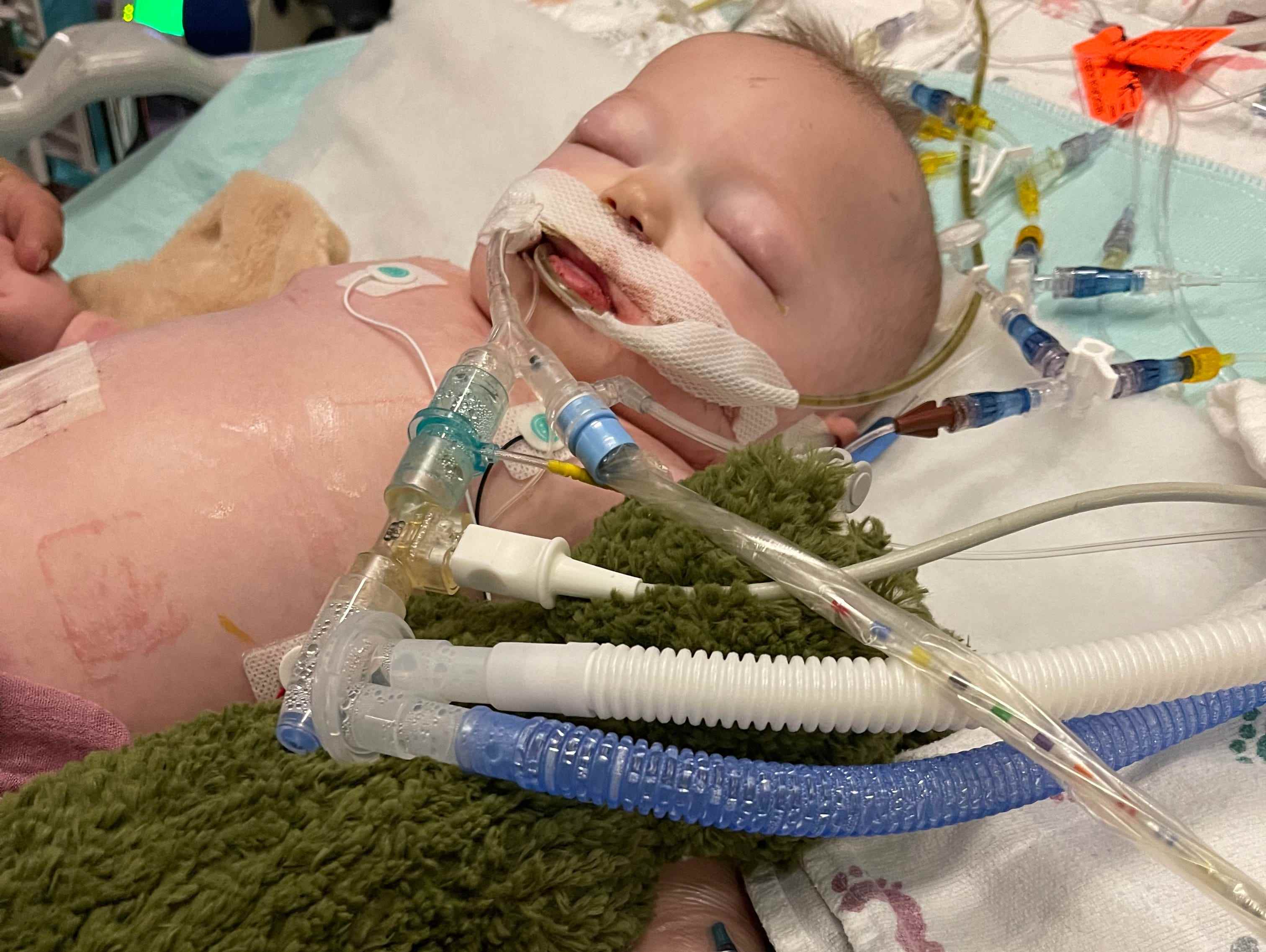 Baby Kennedy Mitchell liegt an einem Beatmungsgerät auf der Intensivstation, nachdem es versehentlich eine Wasserperle verschluckt hat