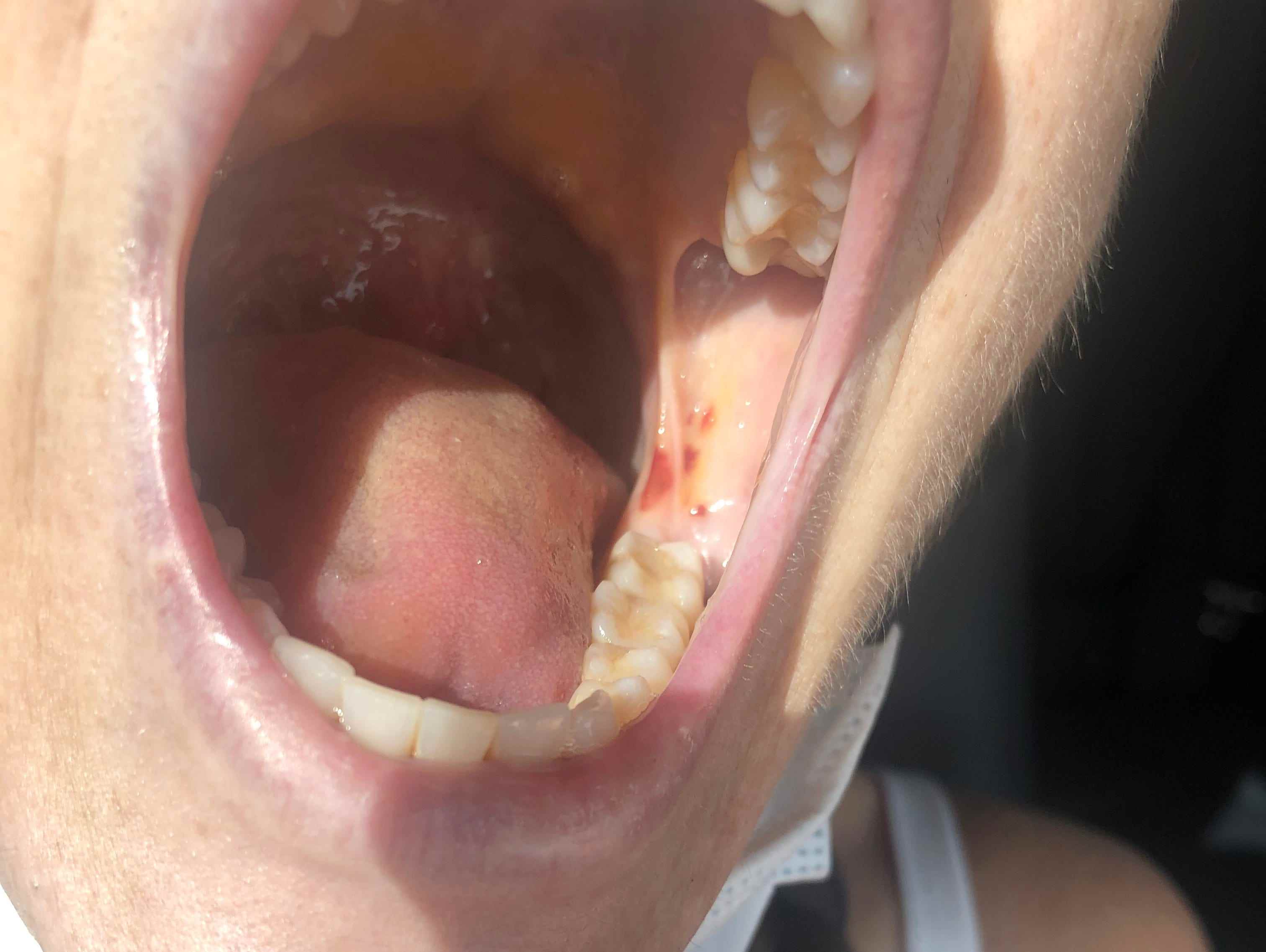Frau öffnet den Mund und enthüllt Wangen- und Zungenwunden
