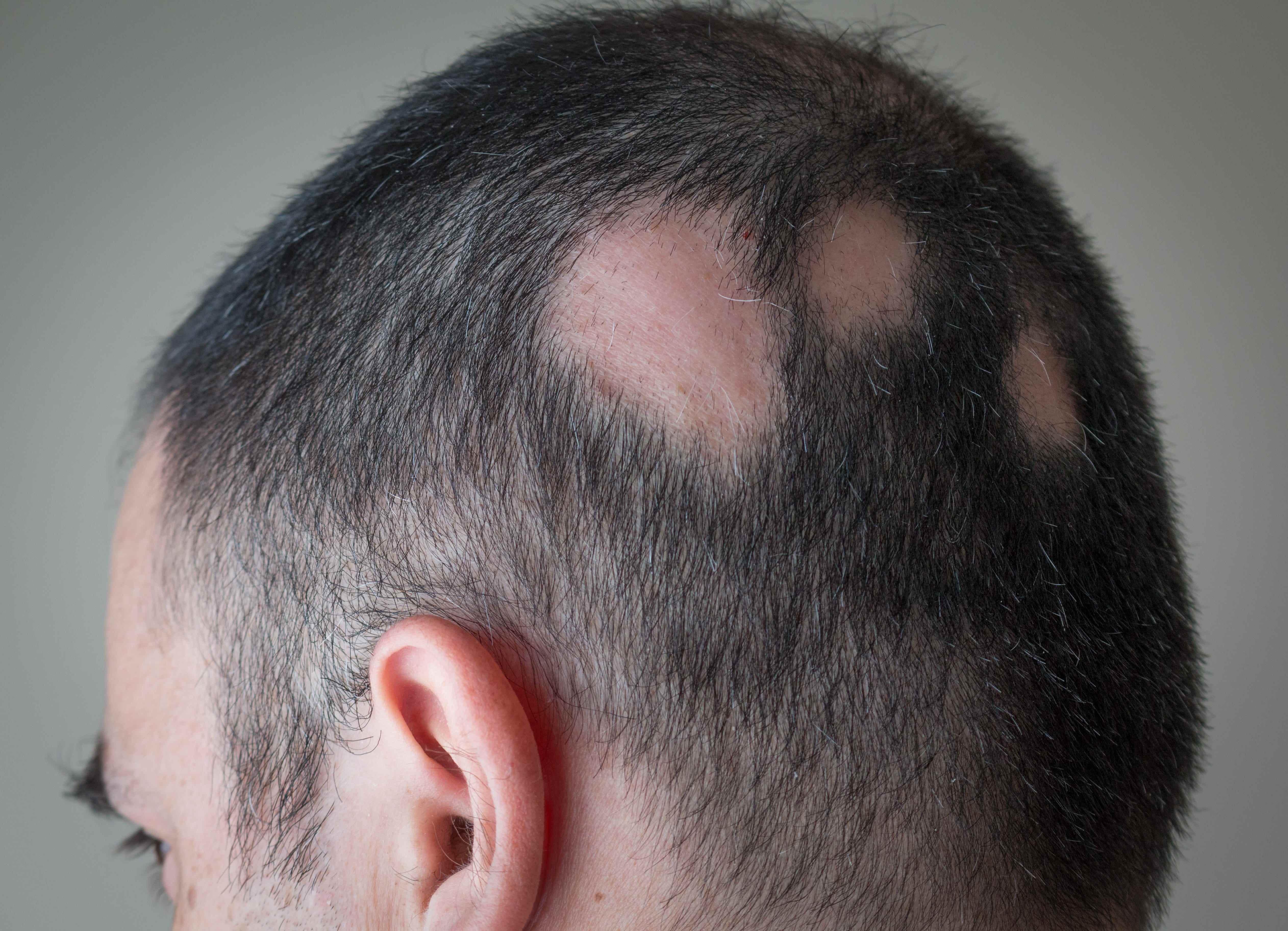 Mann mit Alopecia areata