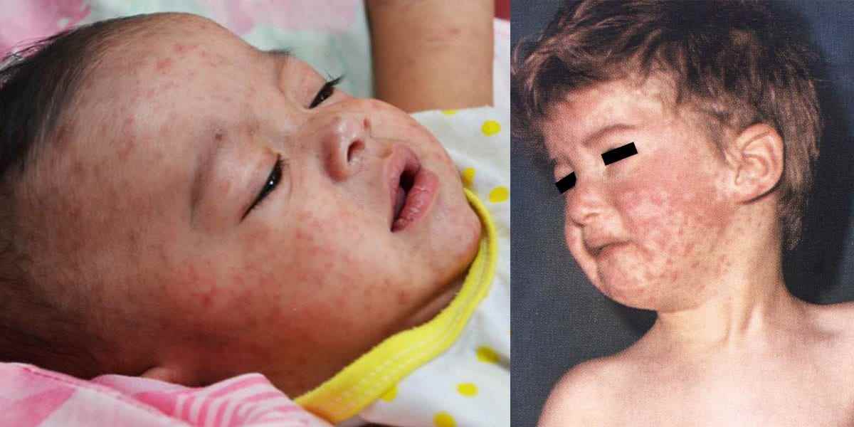 zwei kleine Kinder mit roten Masernausschlägen im Gesicht