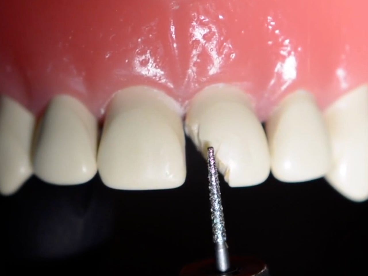 Ein Standbild aus einem Video zeigt ein künstliches Gebiss.  Einer der Zähne ist deutlich abgebrochen