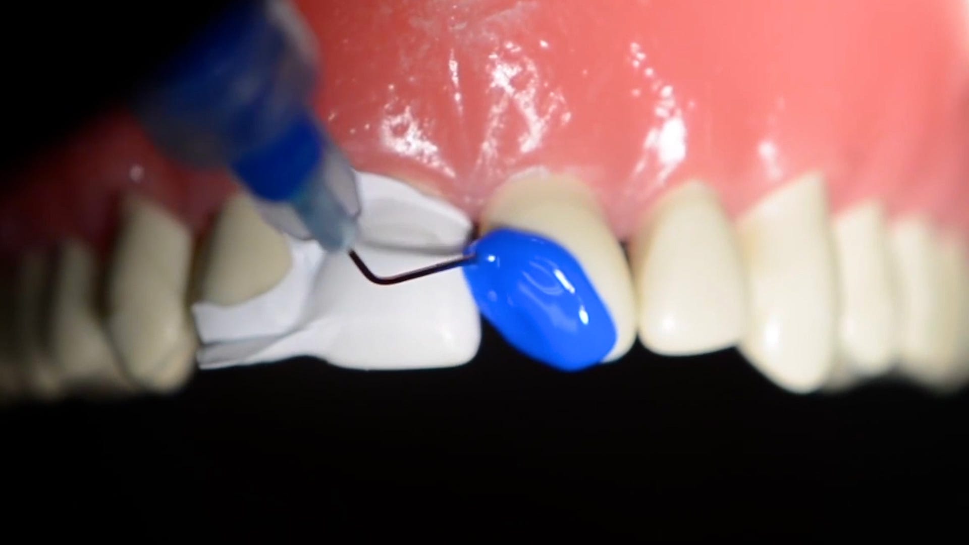 Blaue Paste wird auf den abgebrochenen Zahn aufgetragen.