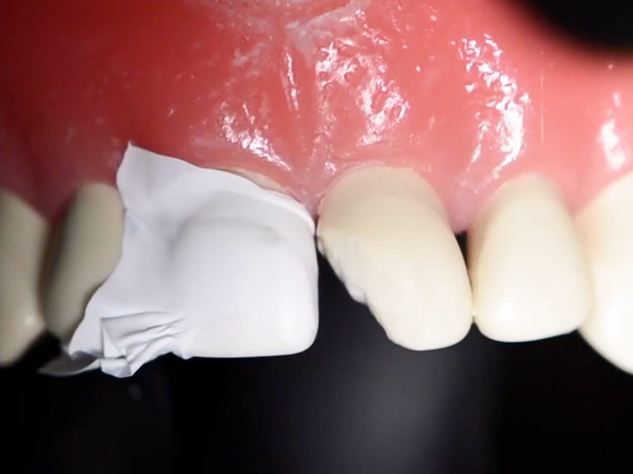 Weißes Klebeband wird auf den Zahn neben dem abgebrochenen Zahn aufgebracht