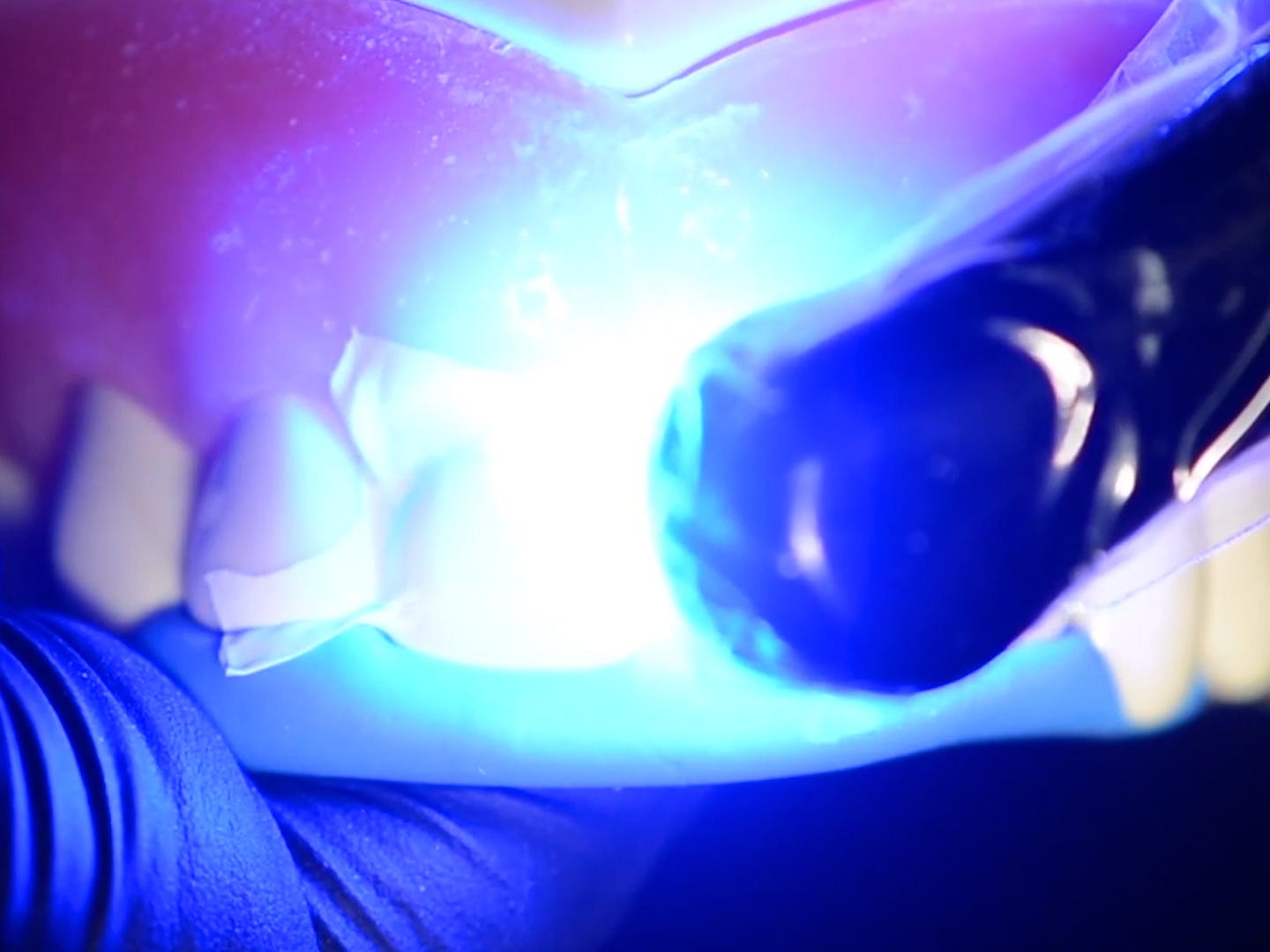 Ein Stab, der gegen den Zahn gehalten wird, gibt intensives blaues Licht ab.