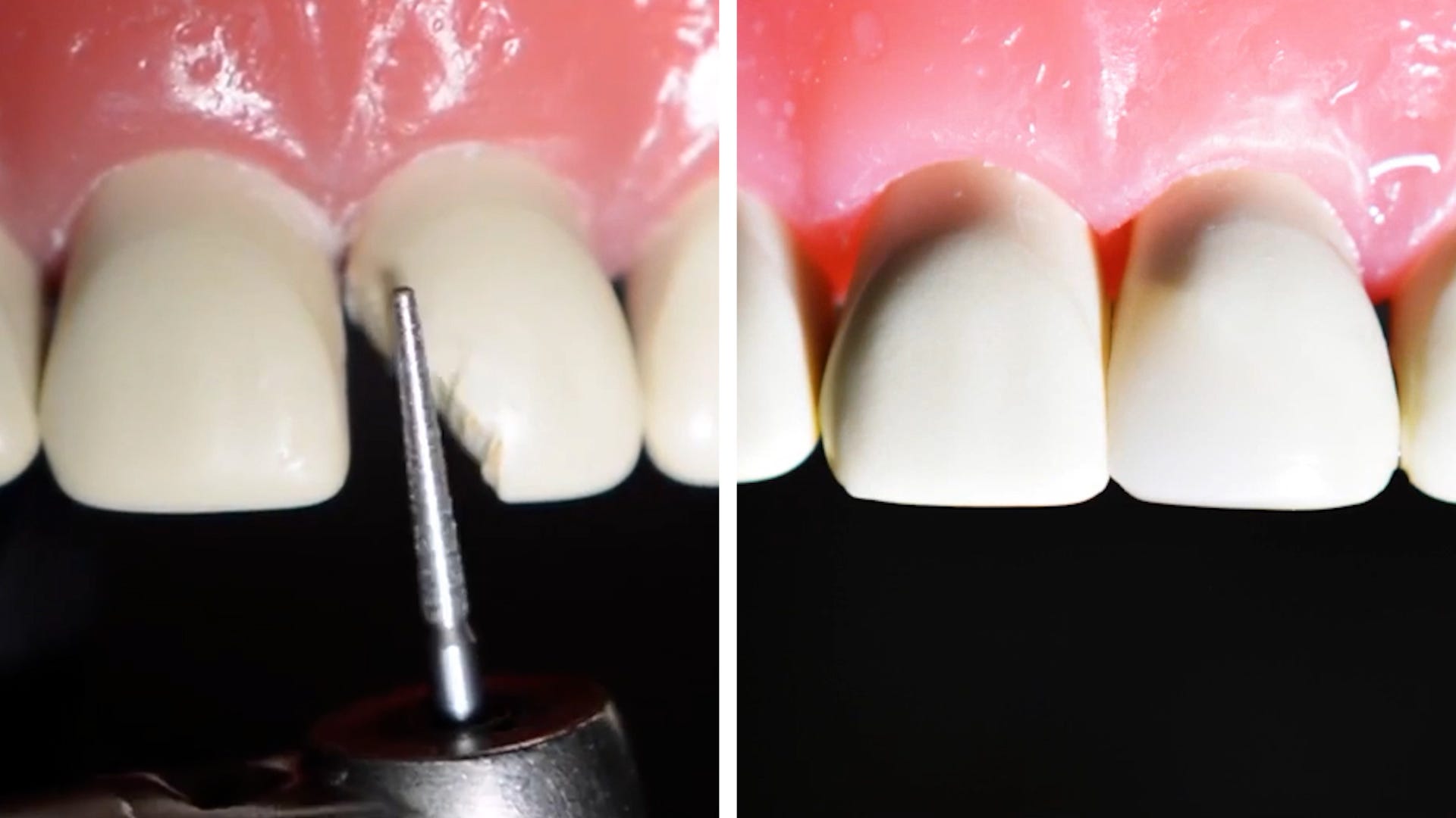 Eine Vorher-Nachher-Aufnahme des Zahns nebeneinander zeigt, dass der gebrochene Zahn vollständig repariert wurde.