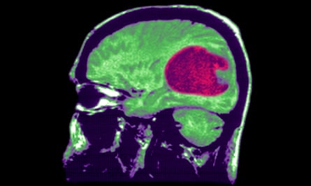 Ein Gehirnscan eines Glioblastomtumors.