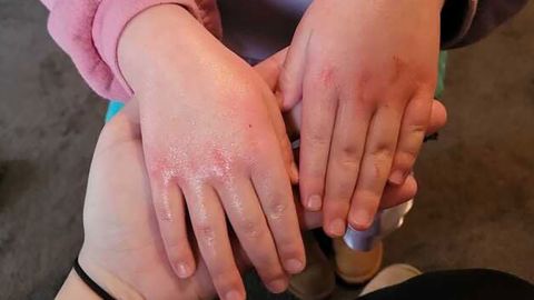 Die 4-jährige Tochter von Ayla Antoniazzi bekam einen Hautausschlag, nachdem sie in Ostpalästina wieder zur Schule gegangen war.