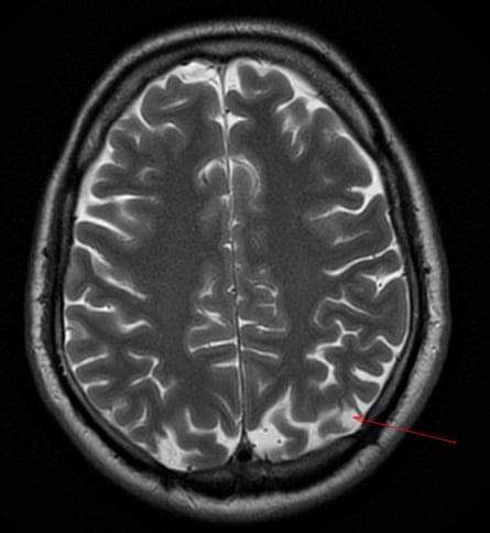 „Ich fühle mich seltsam emotional“ … Der Gehirnscan zeigt die Stelle seiner Biopsie von 1972 unten rechts.