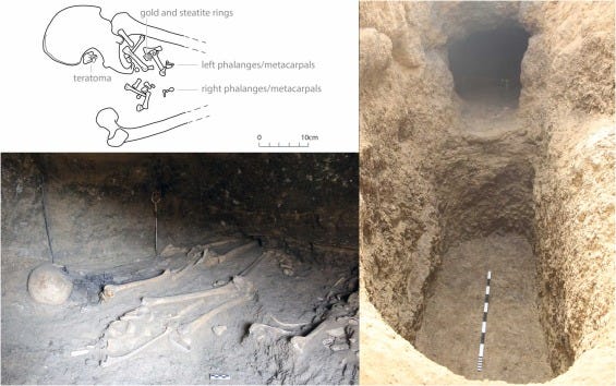 Ein Diagramm beschreibt die Position des Teratoms und des Rings in den in Amarna gefundenen Skelettresten.  Ein Bild dieser Überreste ist unter dem Diagramm dargestellt.  Neben beiden Bildern ist ein Bild eines Grabes zu sehen.