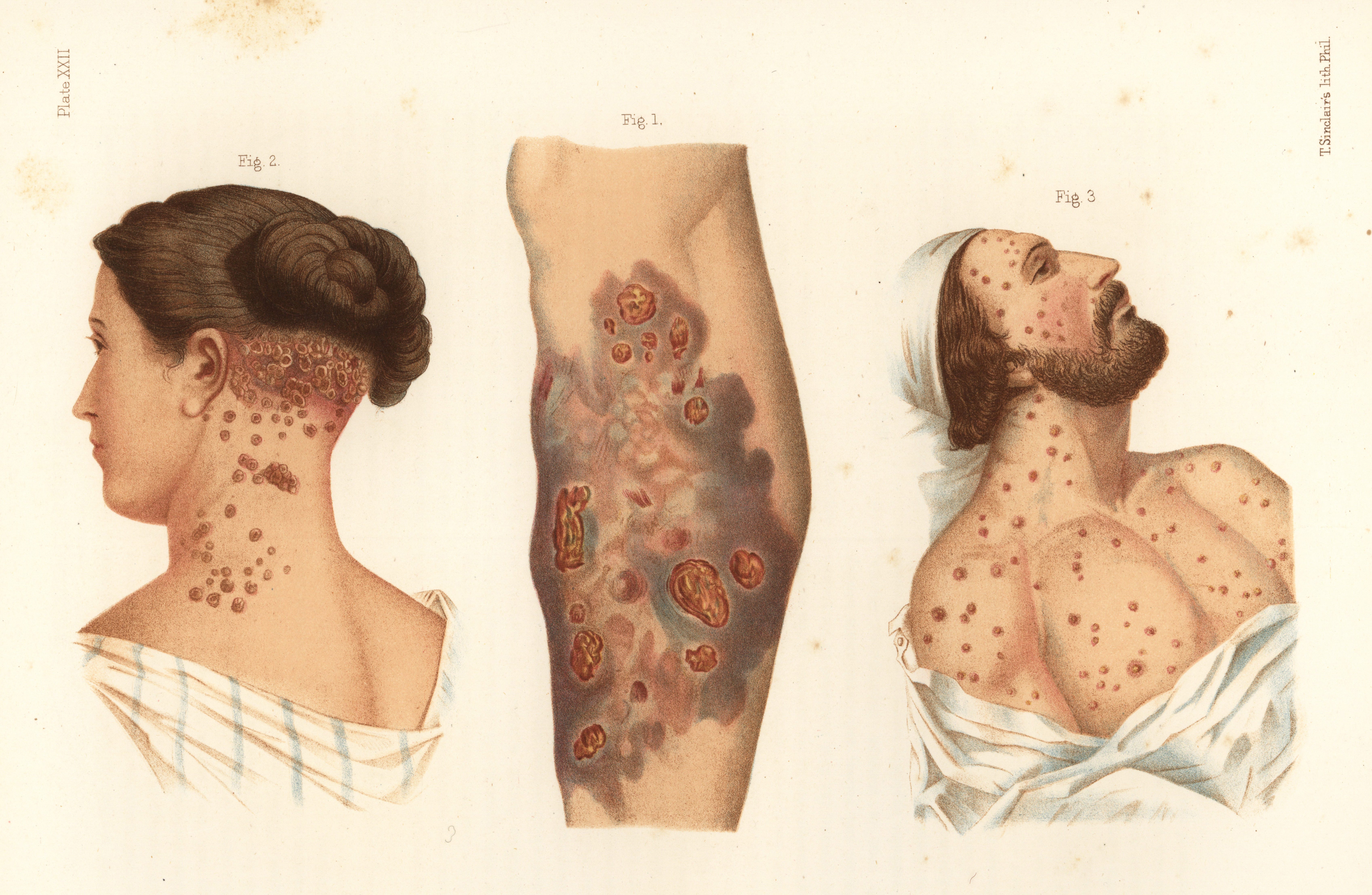 Eine Abbildung zeigt Pocken und Nekrose im Zusammenhang mit unbehandelter Syphilis.