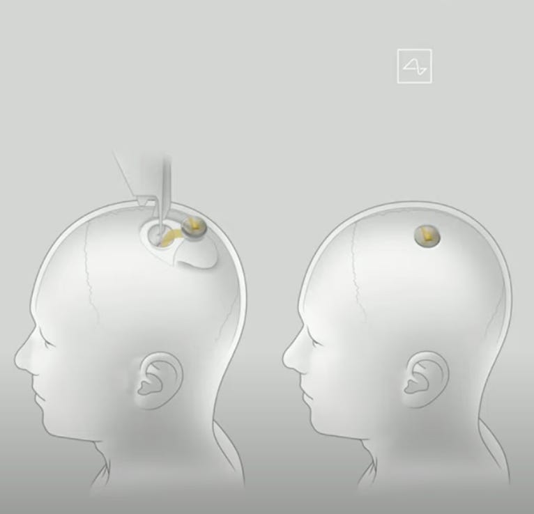 Ein Diagramm zeigt den chirurgischen Eingriff zum Einsetzen eines Neuralink-Gehirnchips in den Schädel eines menschlichen Patienten.