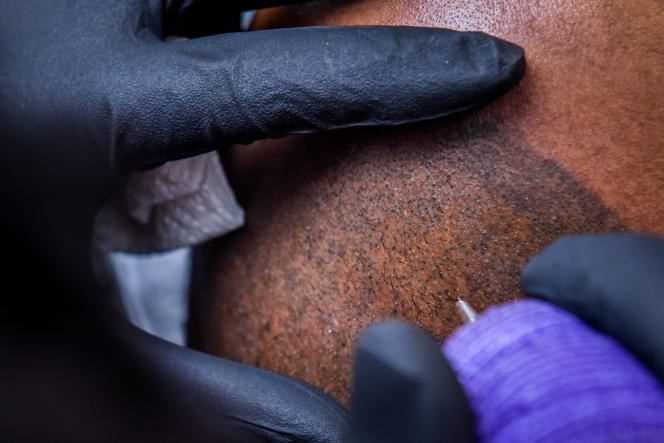 Close-up of micro-pigmentation, medical treatment for imitation of hair on the scalp of bald men.