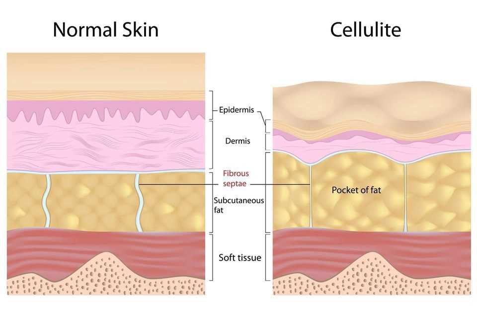 Connective tissue weakness: Graphic cellulite