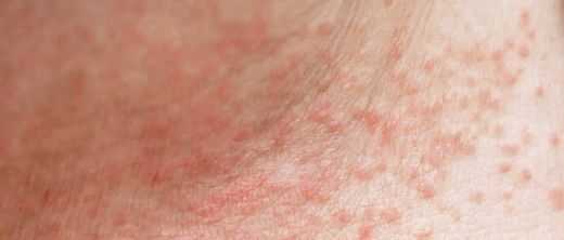Miliaria skin disease