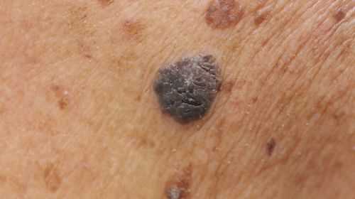 Black skin cancer or birthmark?  These pictures help with recognition!