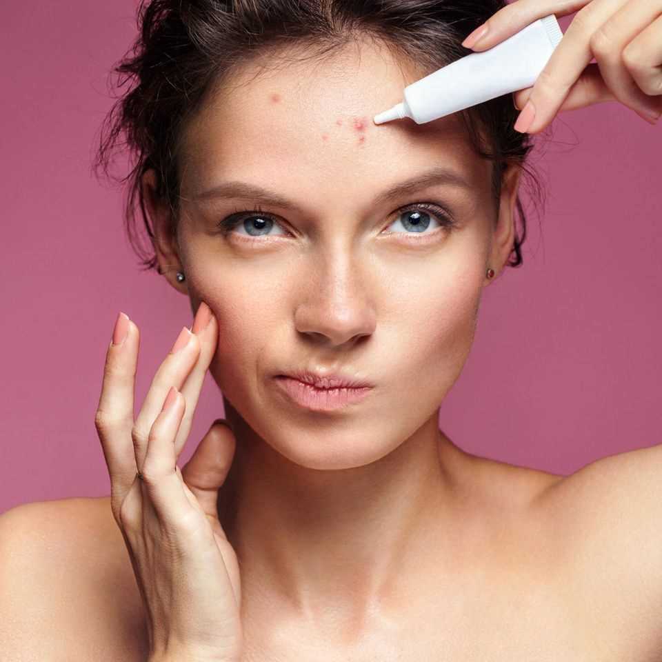 Remove pimples: Young woman with pimples on her face, pimples on her forehead, fighting pimples with cream