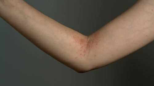 Recognizing atopic dermatitis - the most important symptoms