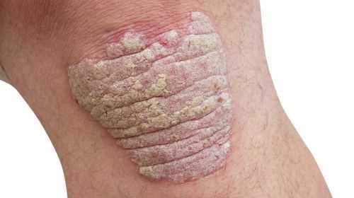 What does psoriasis look like?  Pictures of psoriasis