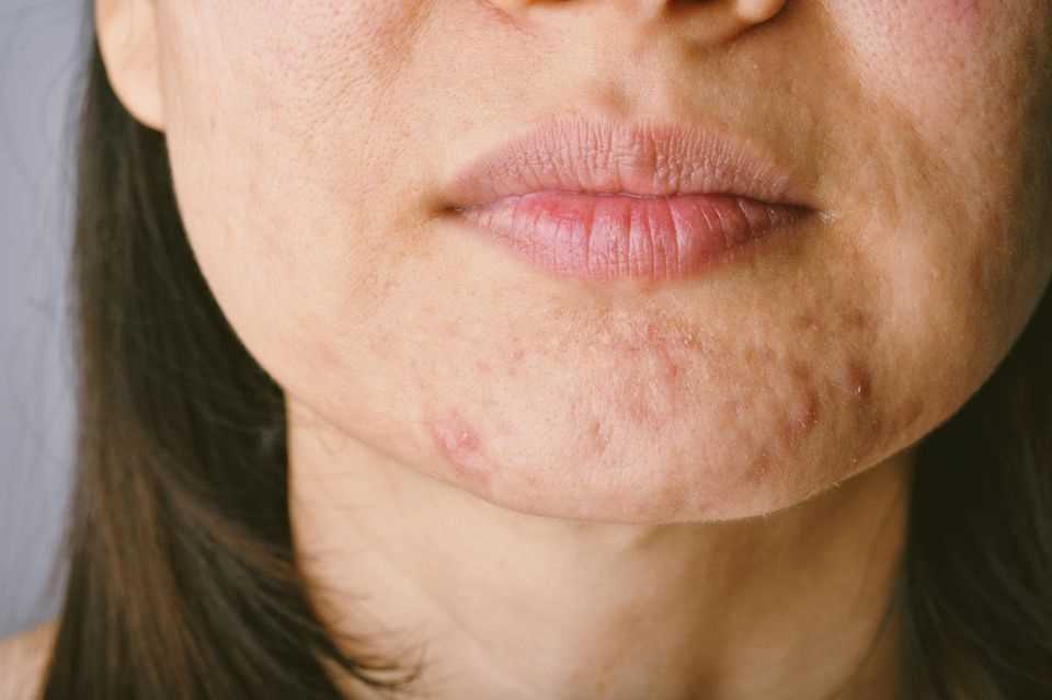 Hautunreinheiten am Kinn einer Frau