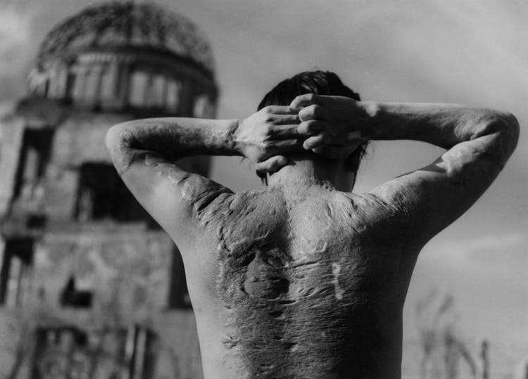 Werner Bischof: Opfer des Atombombenabwurfs über Hiroshima, Japan, 1951.