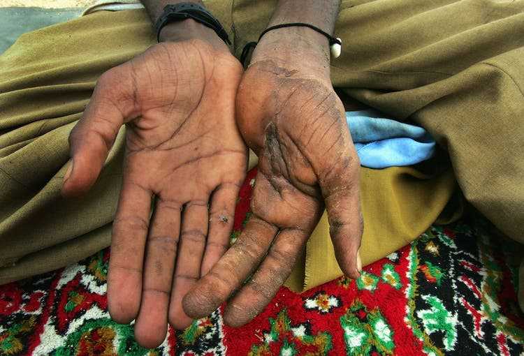 A man who lost two fingers in a Janjaweed attack shows his hands in a 2004 footage.
