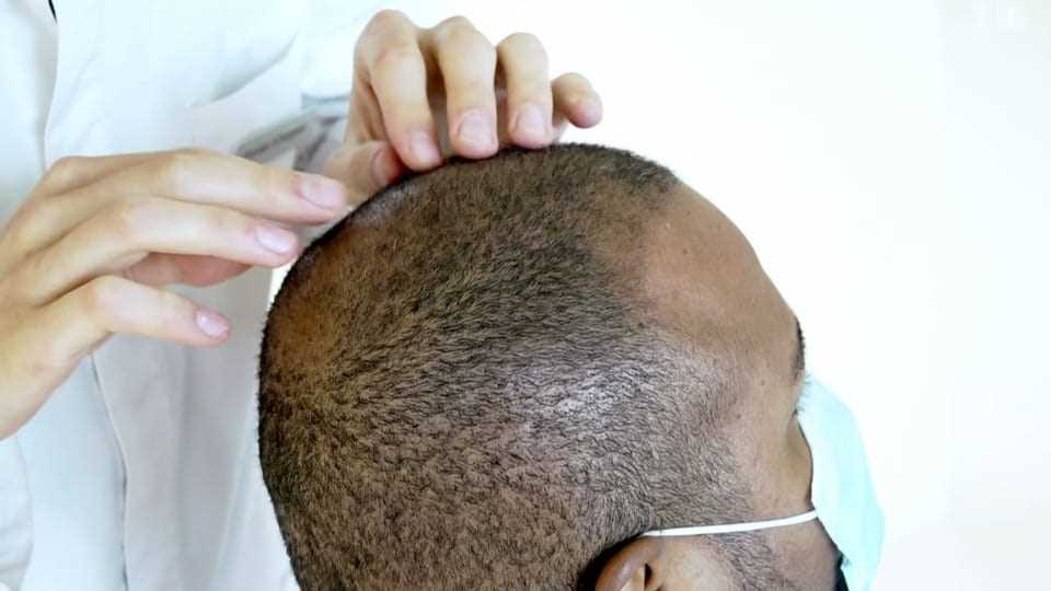Close up of back of head with short hair.  A person in a white coat feels the scalp.