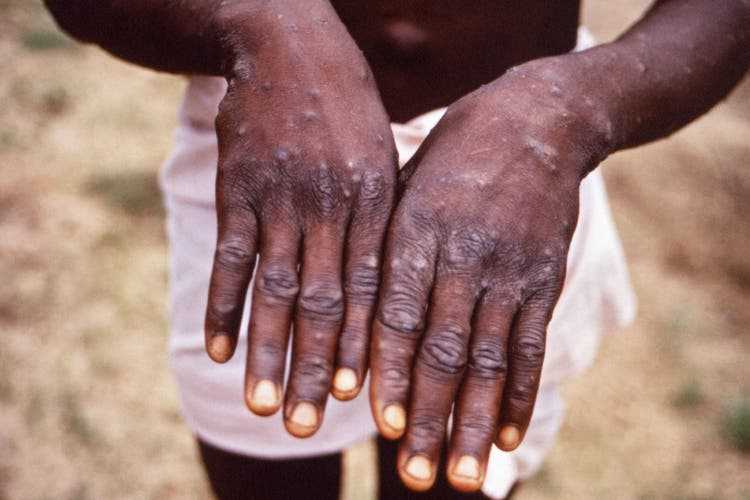 Monkeypox viruses cause a skin rash that is often itchy and sometimes very painful.
