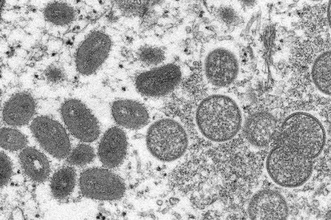 2003 electron microscope image showing mature, oval-shaped monkeypox virions, left, and spherical immature virions, right, obtained from a sample of human skin.