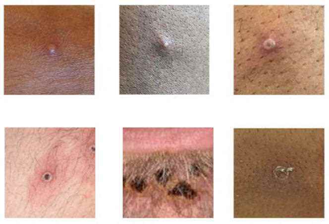 Images showing examples of monkeypox rash collected from Centers for Disease Control and Prevention in the UK.