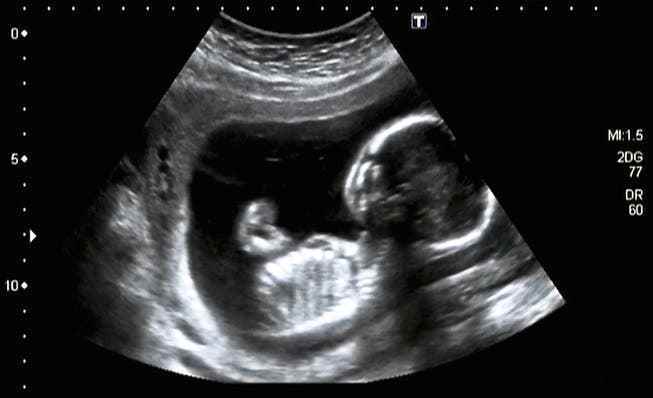Ultrasound scan of a fetus in the fourth month of pregnancy. 