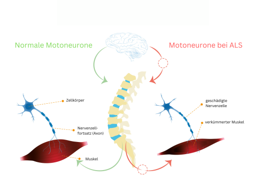 Motor neurons in ALS