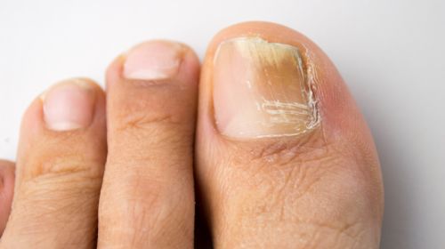 Recognize nail fungus