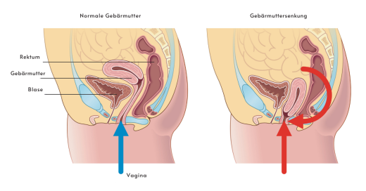 Anatomical graphic of uterine prolapse