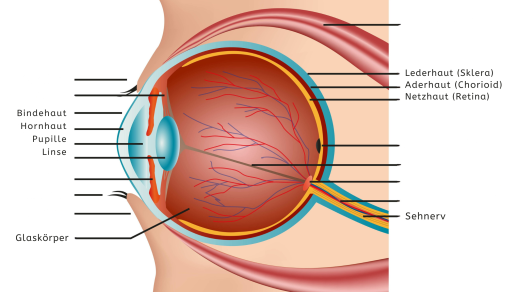 Retinal detachment graphic