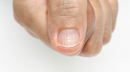 Recognizing nail diseases: What longitudinal grooves etc. mean