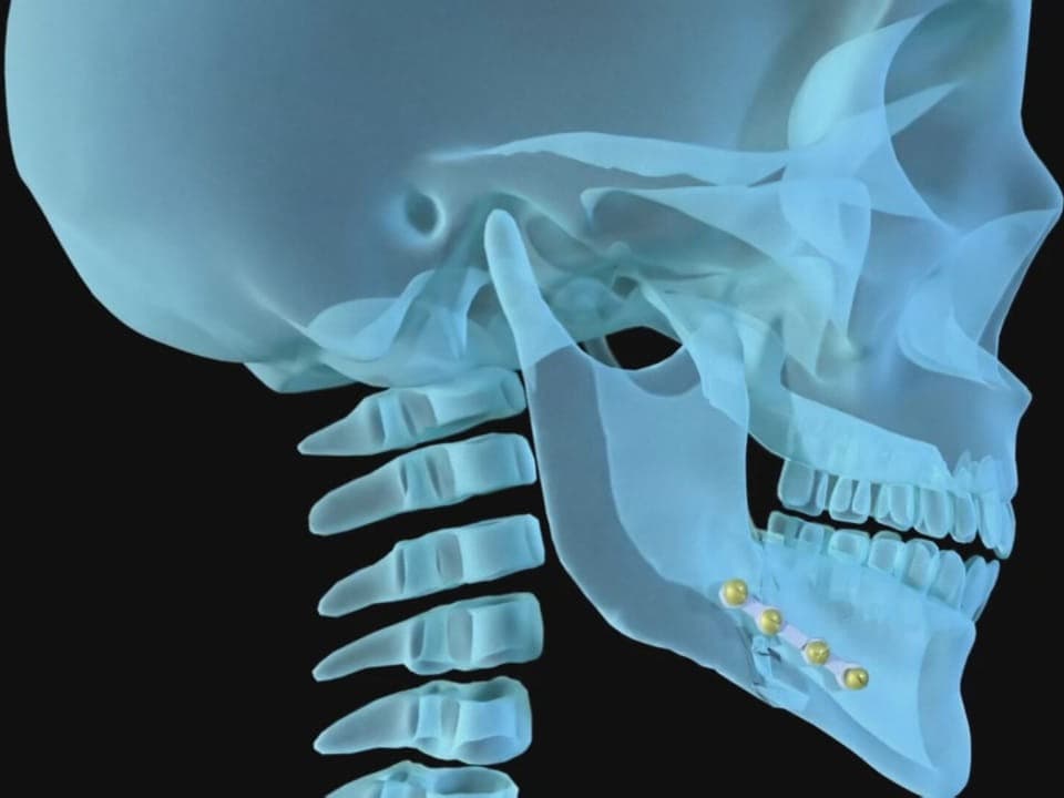 Visualization of an implant on a broken jawbone.