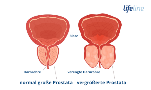 Infografik Prostatatvergrößerung